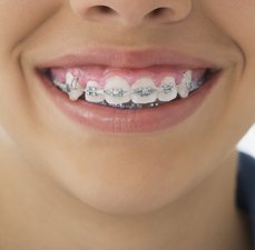 Dentes com  aparelho dica e cuidados
